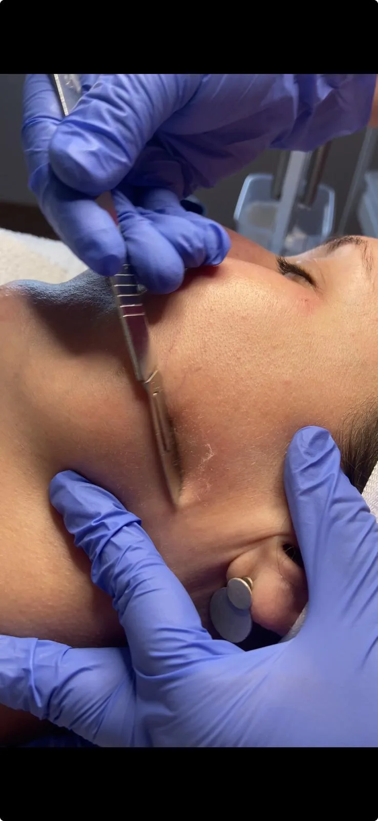 Esfoliação Dermaplaning para uma pele suave e luminosa no PT do Bairro
