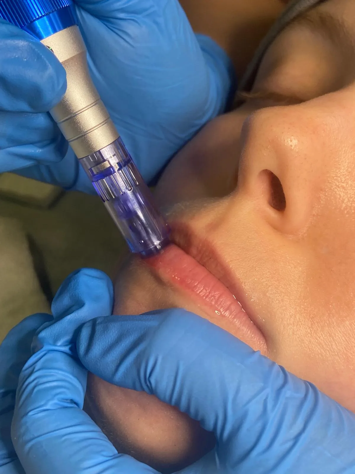 Tratamento Lip Booster para volume e rejuvenescimento labial com colagénio