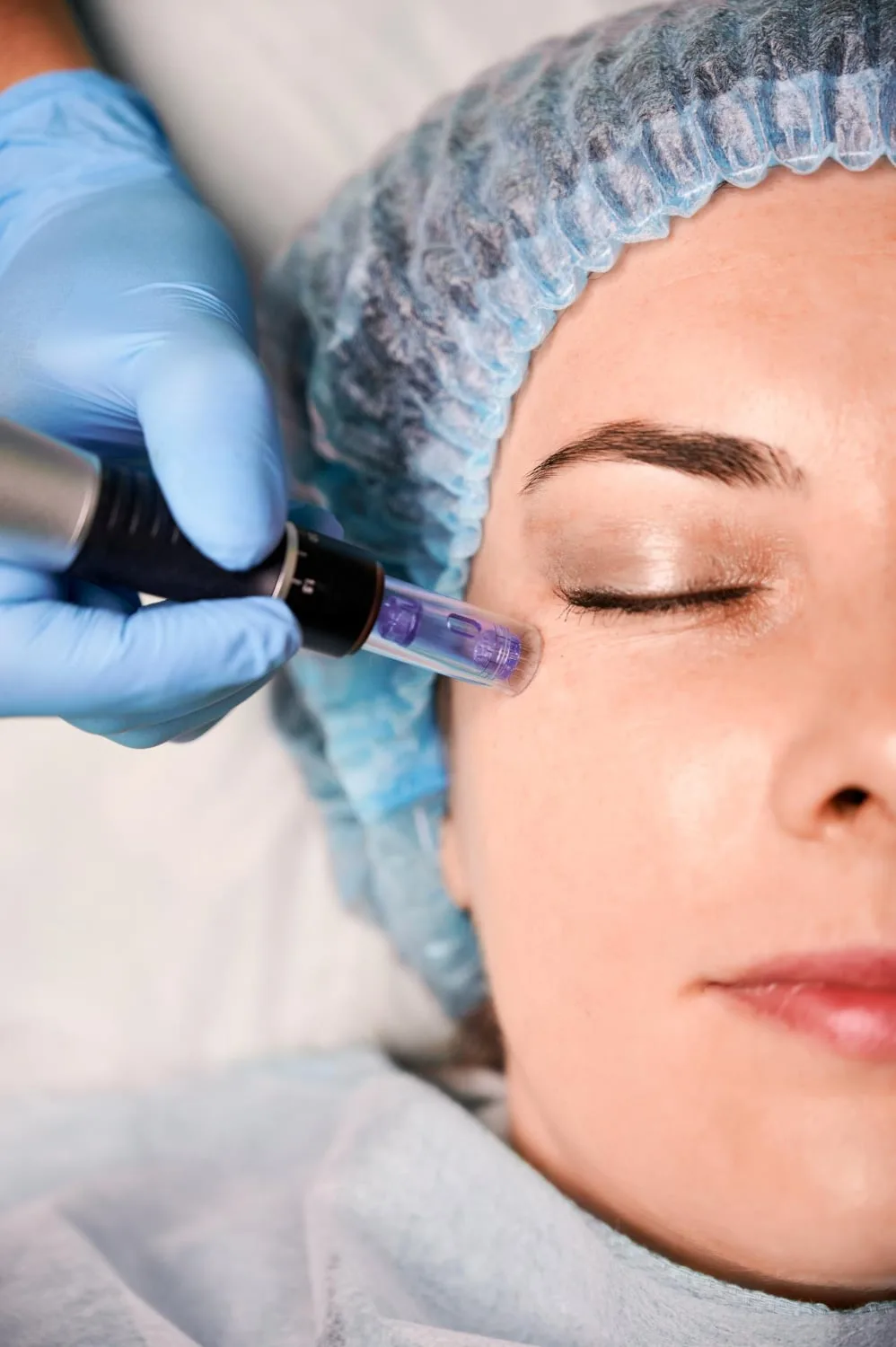 Microagulhamento para rejuvenescimento cutâneo e tratamento de cicatrizes